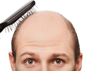 Você já está careca de saber? 6 mitos e verdades sobre a calvície
