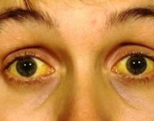 Por que se vacinar contra a hepatite?