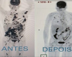 Tomografias mostram regressão de câncer após tratamento inédito