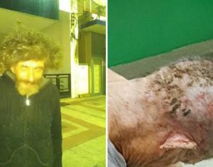 Morador de rua é encontrado com 92 larvas no couro cabeludo