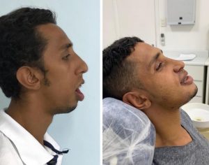 Jovem chamado de ‘monstro’ e ‘babão’ passa por cirurgia e aprenderá a falar; ‘Não vou ser mais humilhado’