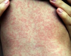 Paraná confirma 42 novos casos de sarampo; 5 deles em Londrina