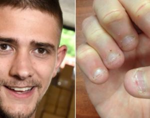 Homem quase morre após infecção grave por mania de roer unha