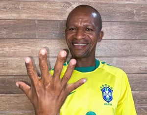 Brasileiro com seis dedos quer festejar hexa com uma mão só
