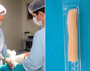 HU de Londrina realiza cirurgia inédita com ‘biovidro’ para tratar infecção óssea